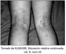 Tratamiento de Dermatitis Atópica, Tomado de ELSEVIER educación médica continuada