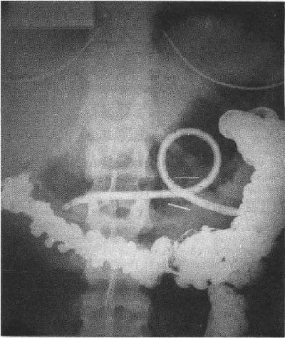 Gastrostomía Endoscópica