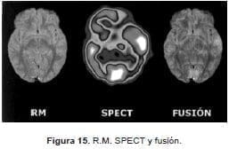 R.M.SPECT y fusión