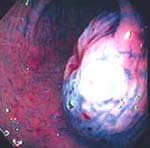 Lesión coloreada con índigo carmín y levantada con inyección submucosa