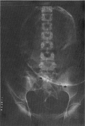 Radiografía simple del abdomen