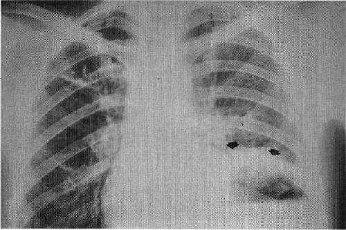 Radiografía del tórax
