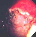 Resección endoscópica del carcinoma