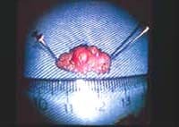 Segmento de mucosa y submucosa completamente resecado, Pacientes tratados con REM utilizando copa endoscópica, Mucosectomía Endoscópica con Copa Plástica