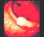 Carcinoma gástrico temprano antral tipo IIa