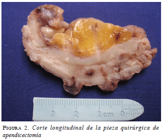 figura2-apendicectomia