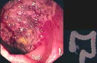 Ulceración de la mucosa y submucosa 