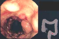 úlceras con tejido de granulación y peusopólipos