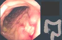 úlcera con tejido de granulación