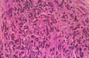 Carcinosarcoma primario de hígado