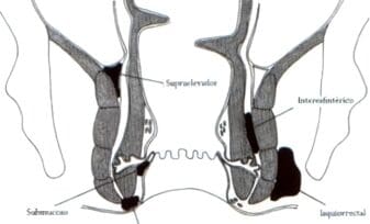 Clasificación abscesos anorrectales