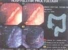 Imagen Endoscópica de Ulcera Solitaria 2