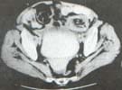 Tomografía axial del abdomen