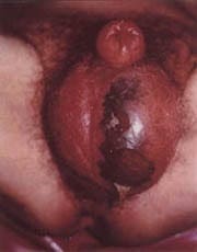 Necrosis escrotal con descamación