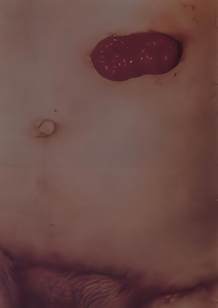 Colostomía