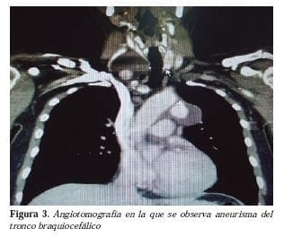 Angiotomografia de un aneurisma del tronco braquilocefalico
