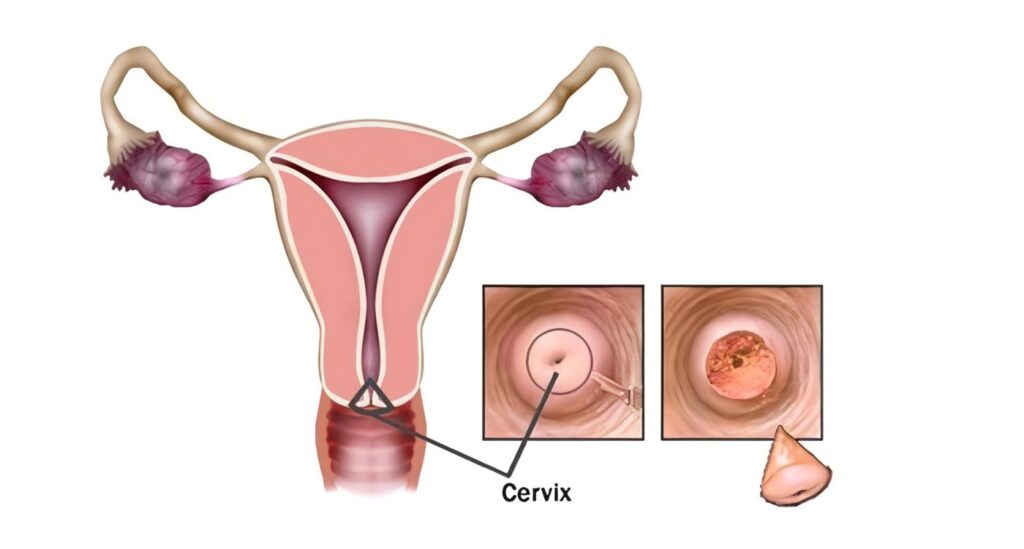 Cervix Uterino