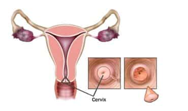 Cervix Uterino