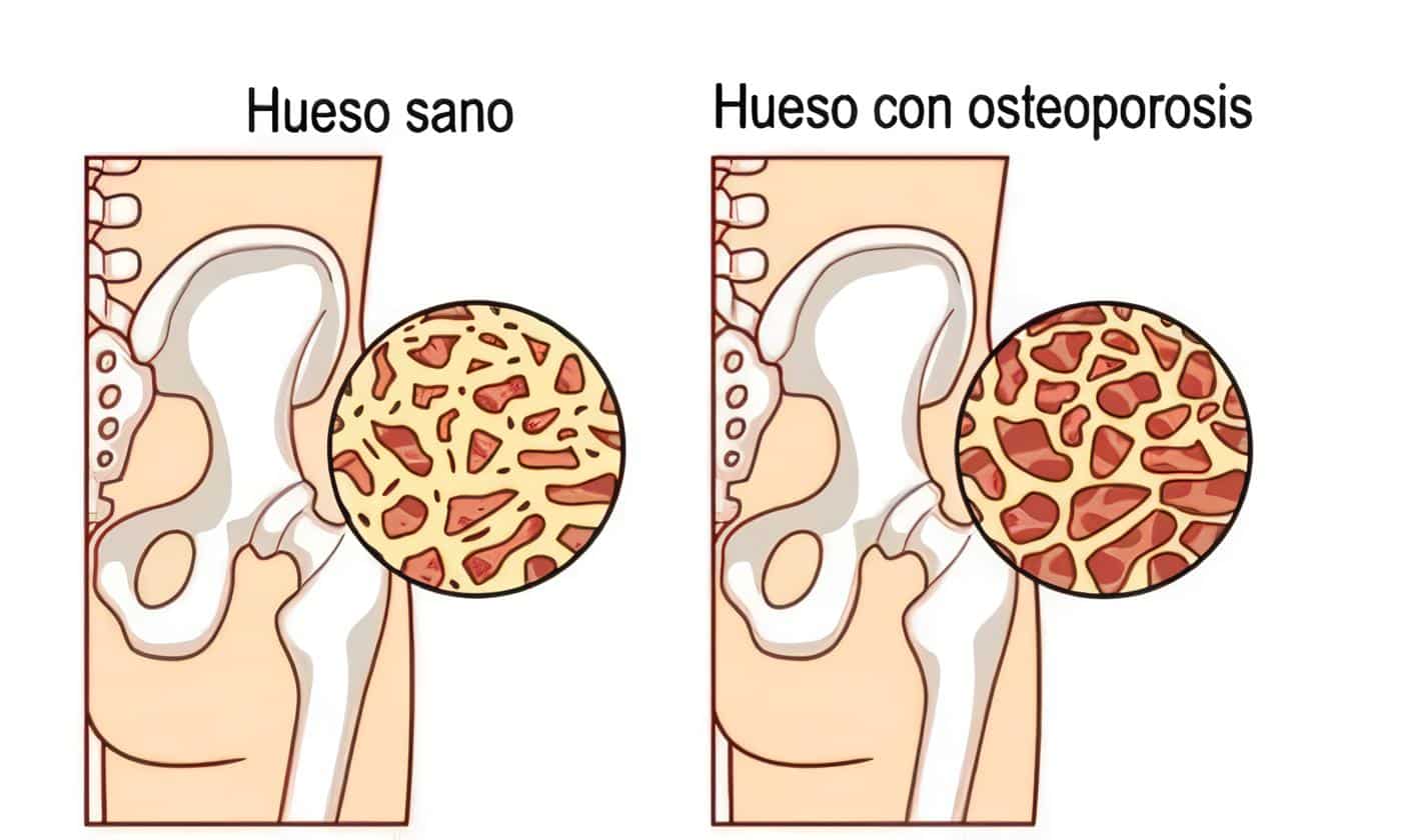 Osteoporosis