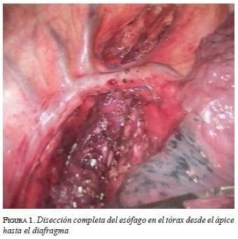 figura1-diseccion-esofago