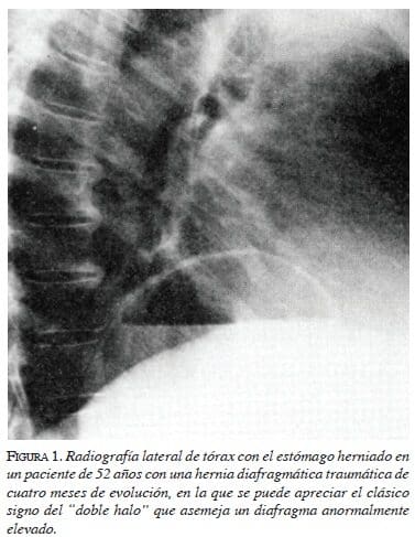 figura1-radiografia-lateral