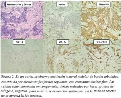 Lesion-tumoral-nodular
