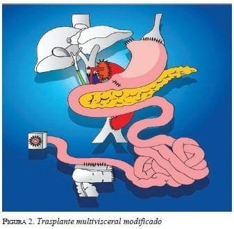 figura2-trasplante-multivisceral