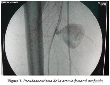 figura3pseudoaneurisma-de-la-arteria-femoral