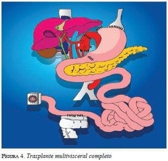 figura4-trasplante-multivisceral