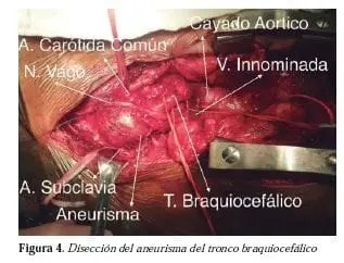 Diseccion de aneurisma del tronco braquiocefalico