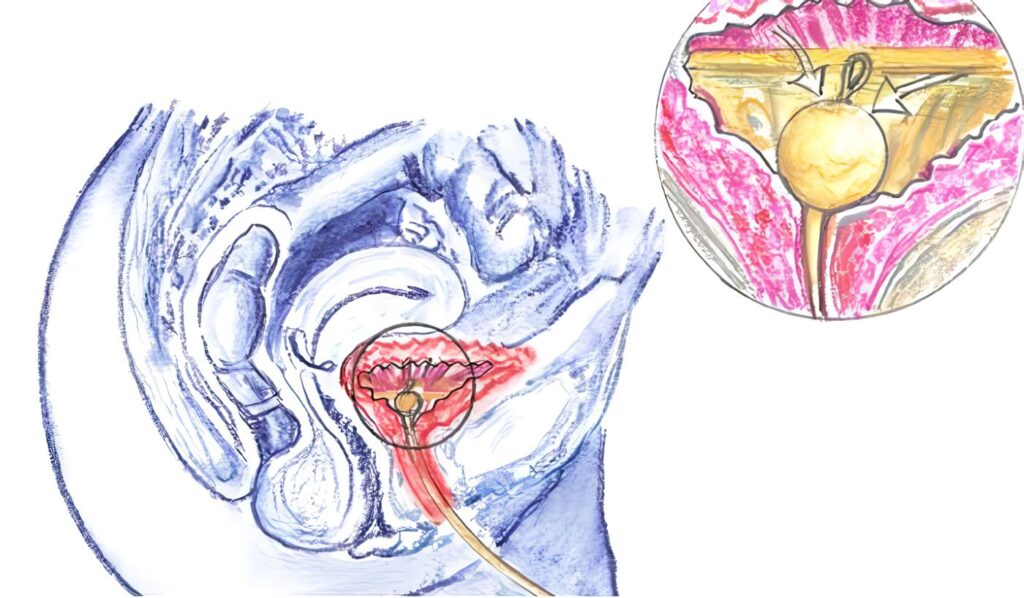 cateterismo uretral - sonda vesical