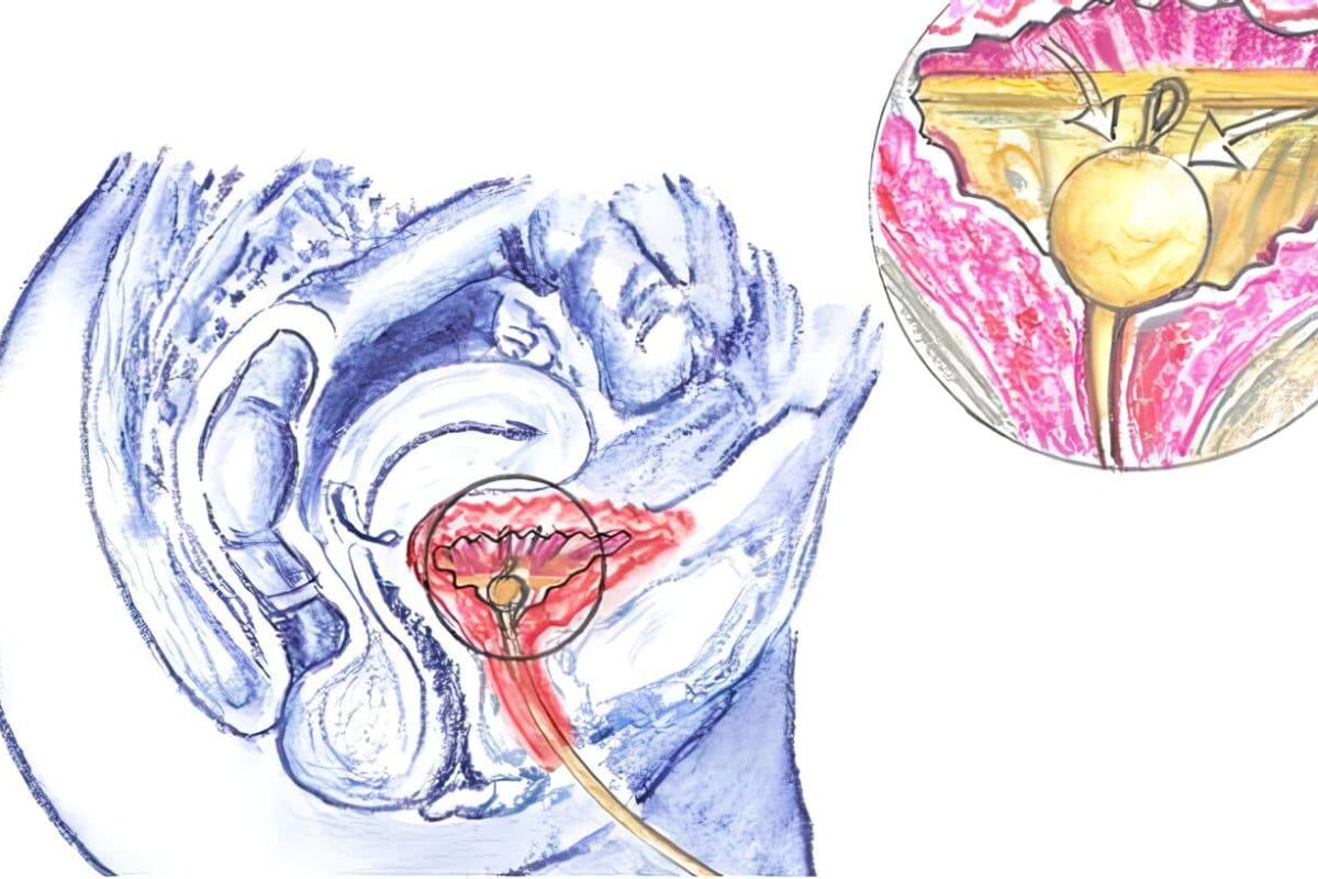 cateterismo uretral - sonda vesical