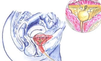 cateterismo uretral - sonda vesical