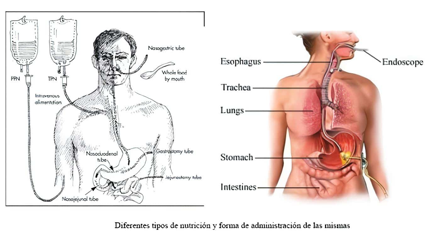 Alimentación en gastritis