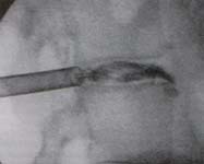 Imagen fluoroscopica lateral de la discografia