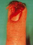 Lesion traumatica de punta de dedo