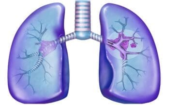 Etapas cáncer pulmón