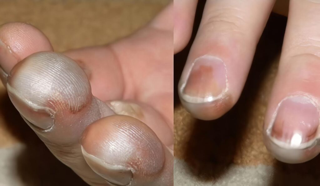 Complicaciones de Lesion con frio