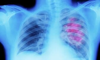 Cáncer pulmonar ocupacional