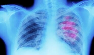Cáncer pulmonar ocupacional