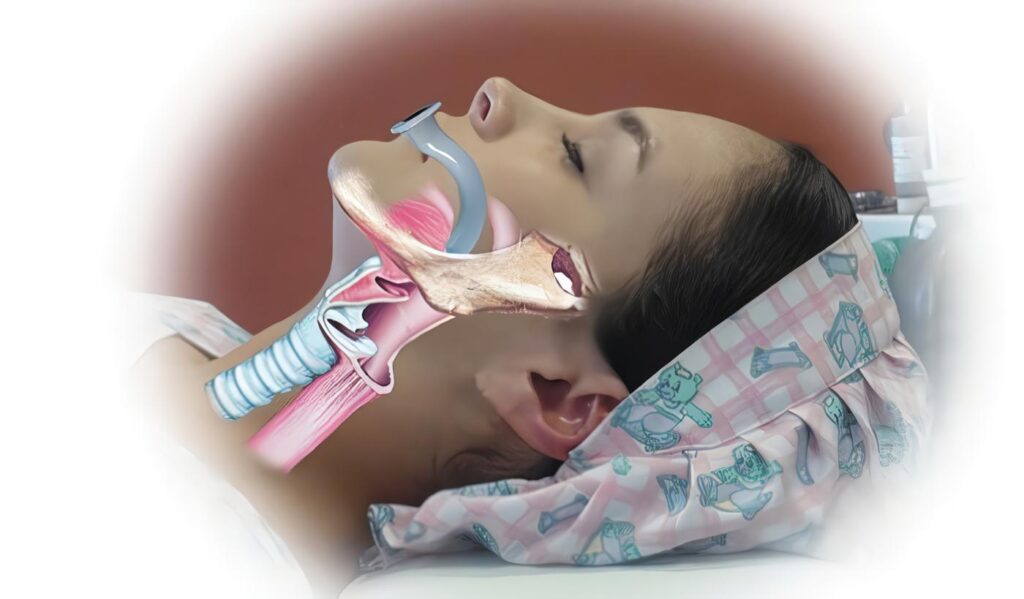 Cánulas Orofaríngeas en Vía Aérea