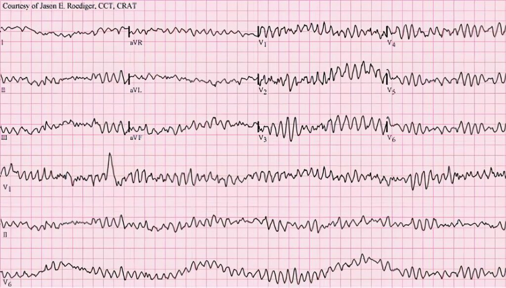 Desfibrilación Externa Automática