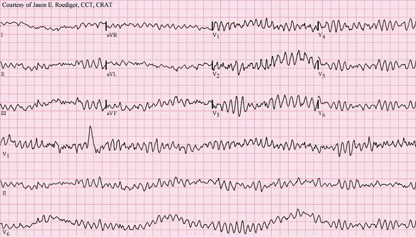 desfibrilacion externa automatica