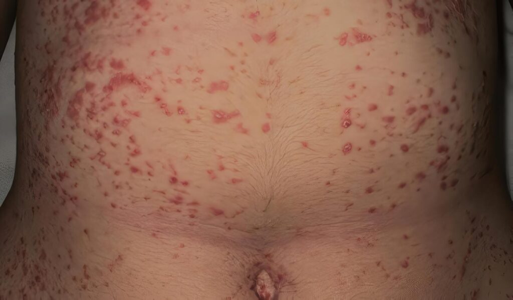 Lesiones Cutáneas por Calor