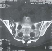 Tomografía axial computarizada que evidencia osteolisis y secuestros óseos