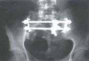 Vista radiográfica anteroposterior de la técnica