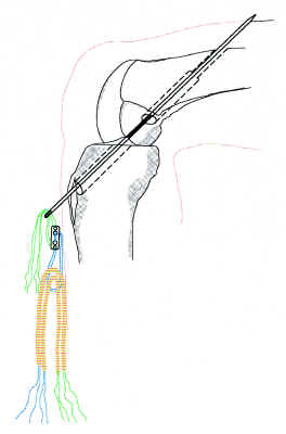 Sistema endobotón-conector-injerto por el túnel femoral