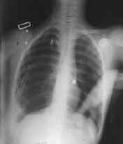 Derrame pleural derecho, con tubo de tórax