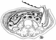 Disección del saco peritoneal y acceso al músculo psoas