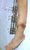cortamiento de la extremidad, alargamiento óseo(7cm).